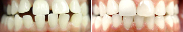 Case - Gapped Teeth