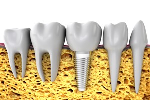 Dental Implant Side View