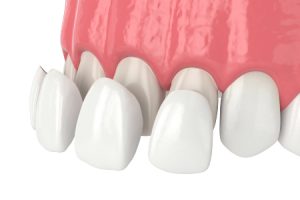 Beautiful Porcelain Veneers