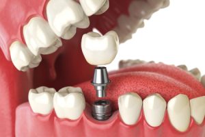 Dental Implants Illustration