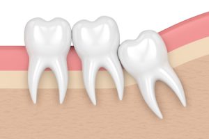 Wisdom Teeth Crowding