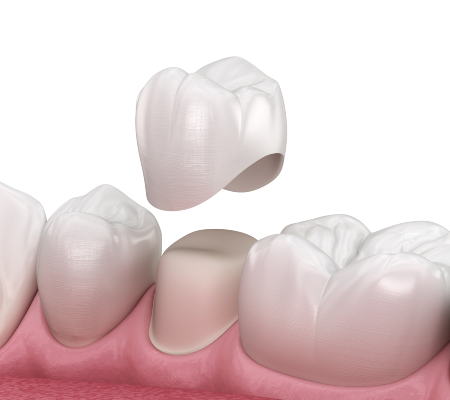Premolar Dental Crown
