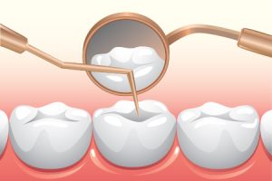 Dental Prevention Checkup